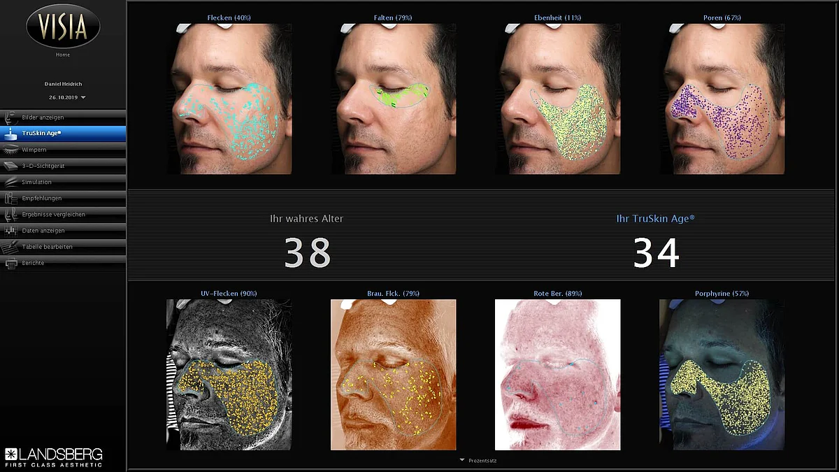 Aufnahme der computergestützten VISIA-Hautanalyse (Canfield VISIA) im REVIDERM skinmedics Institut in Rheinbach